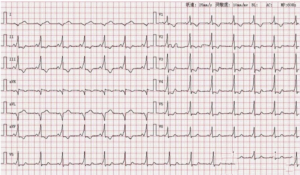 阿斯综合征心电图图片