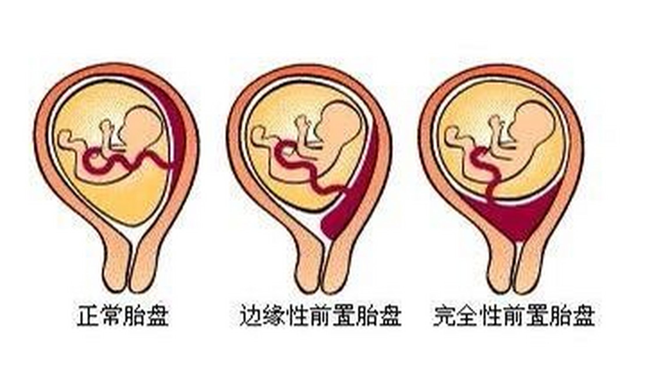 球拍状胎盘和子宫肌瘤 好孕笔记—问题篇3 孕19周给宝宝照了个二级