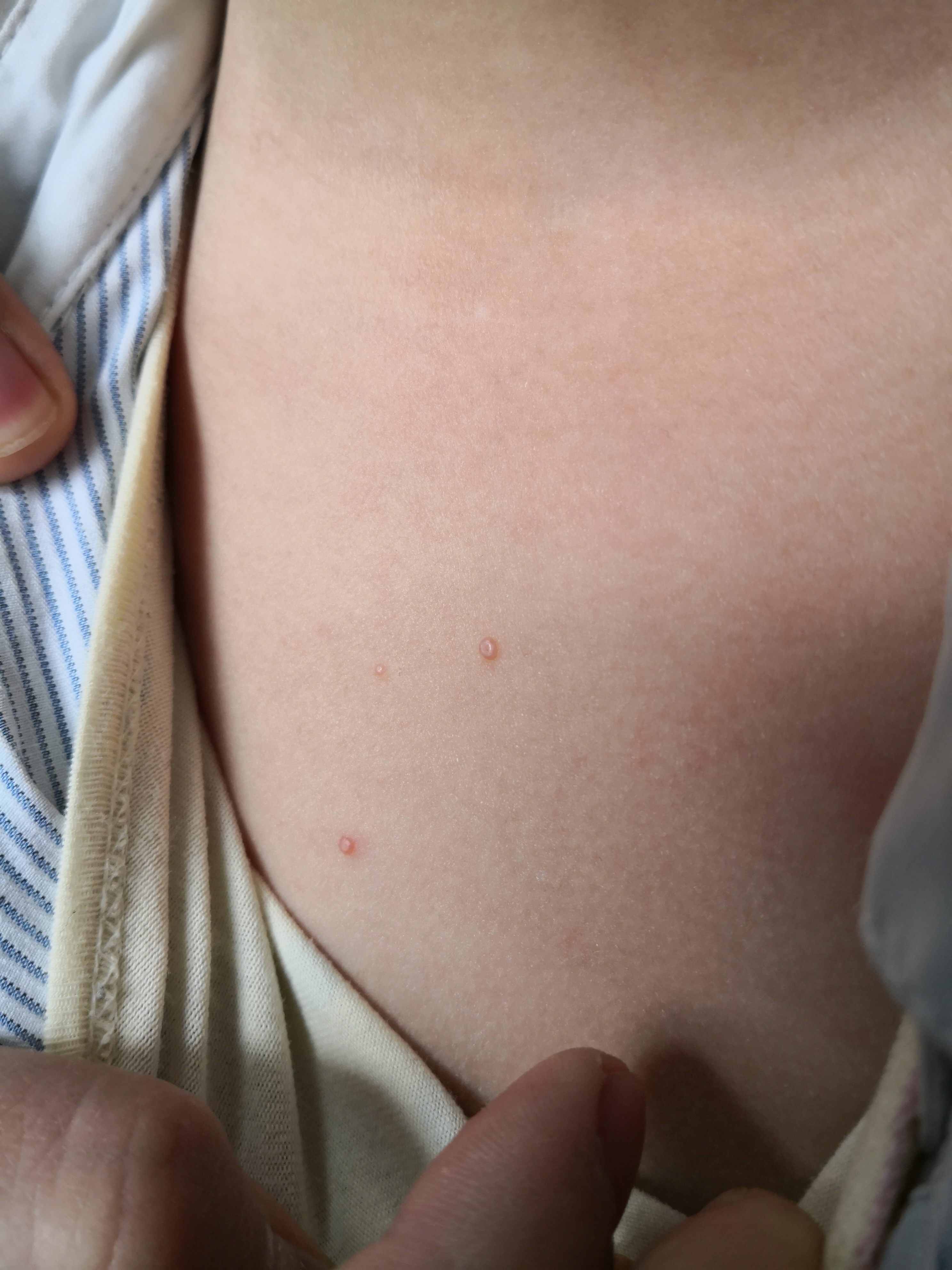 儿童颈周和前胸部位的传染性软疣症状#传染性软疣# 可以使用药物治疗