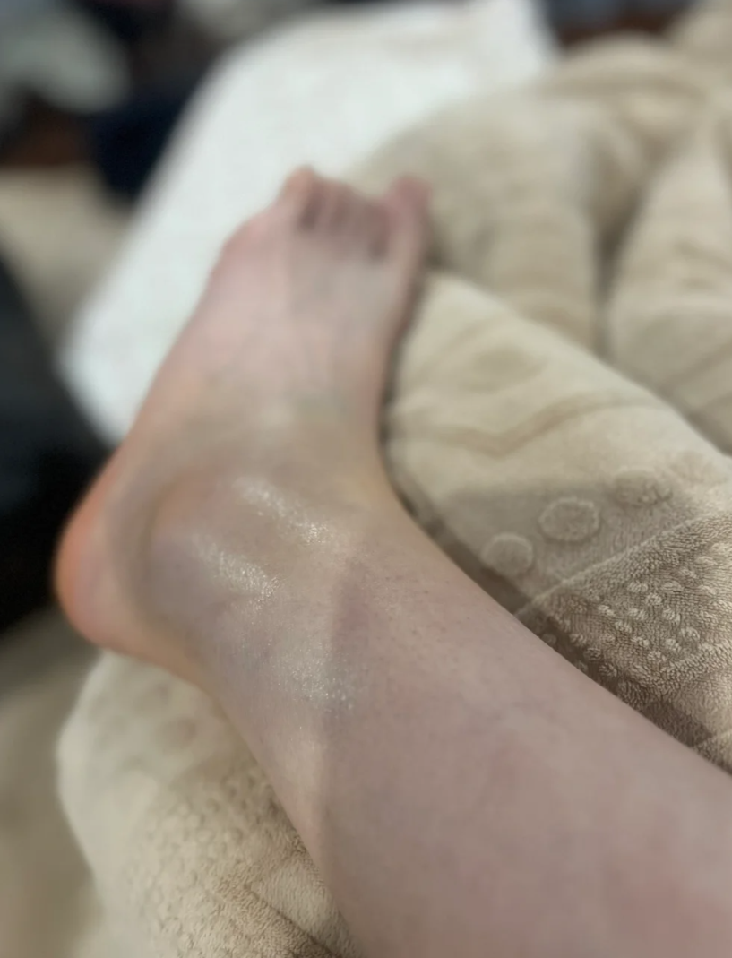 脚崴了脚侧面鼓个包硬硬的怎么回事怎么办?