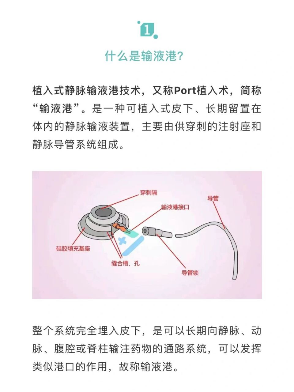 植入式静脉输液港操作维护 本期将介绍: 11566什么是输液港 215