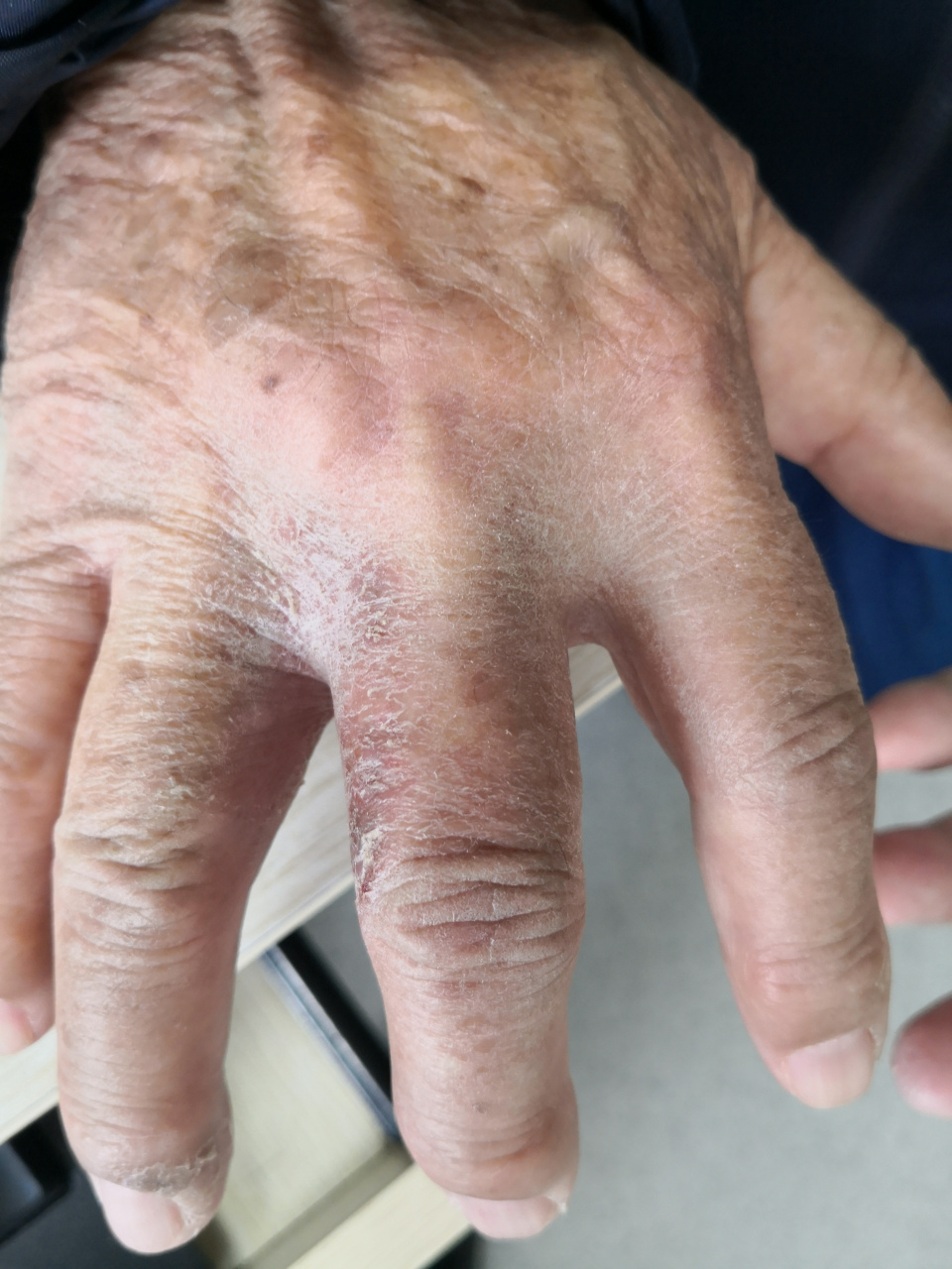 手掌手指的水疱脱屑症状.#过敏##手癣
