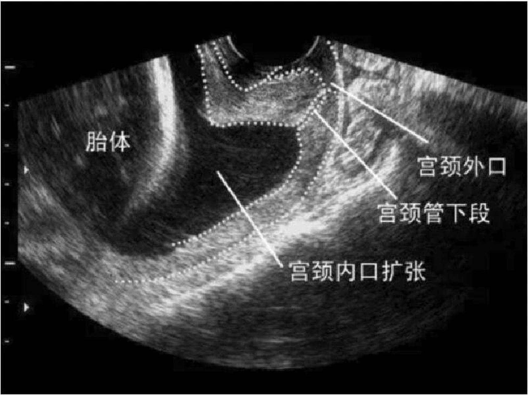 宫腔分离图解图片