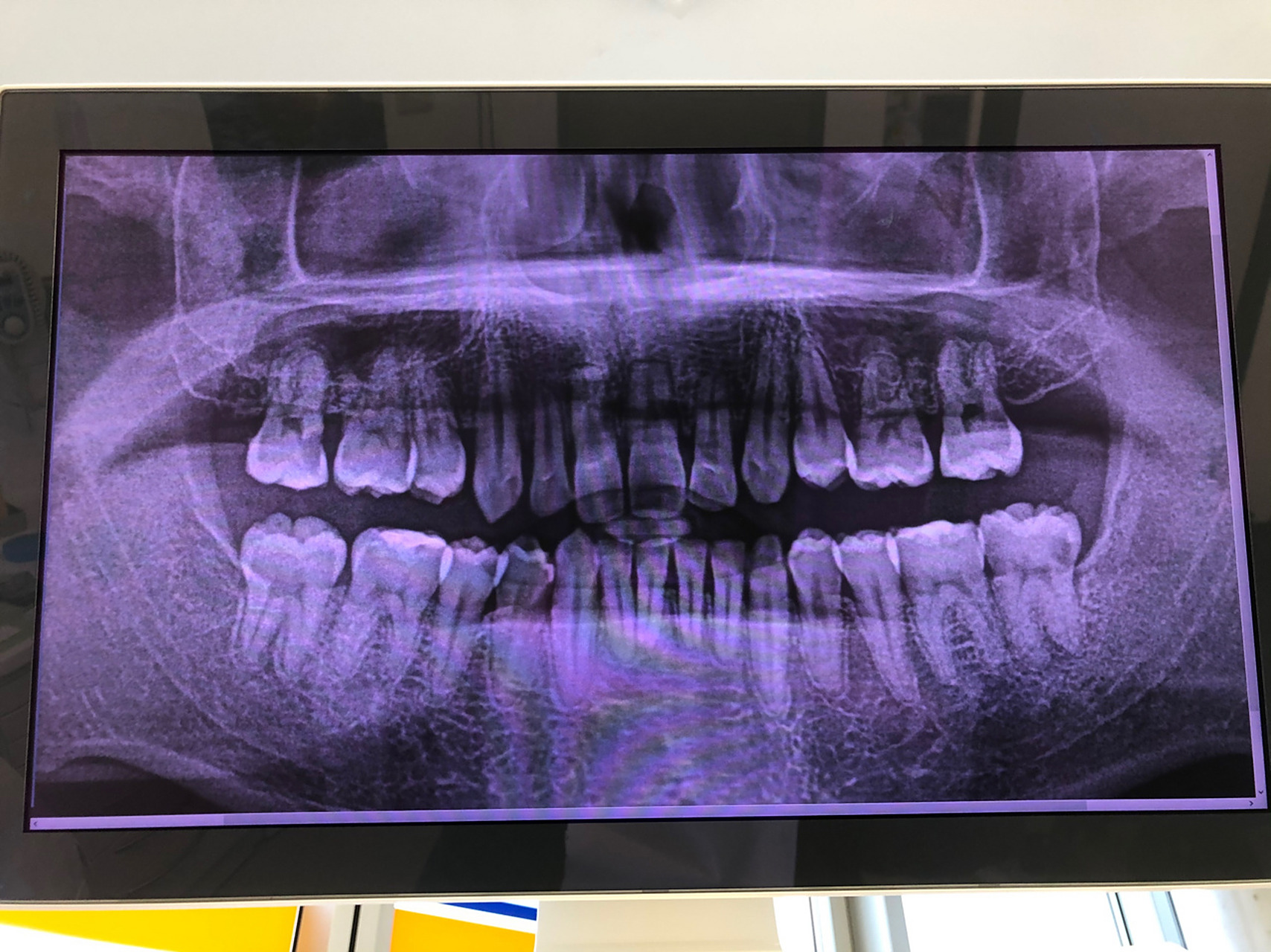 左下第7颗牙有邻面龋,医生说大概蛀了20%,不能补了,因为是邻面并且是
