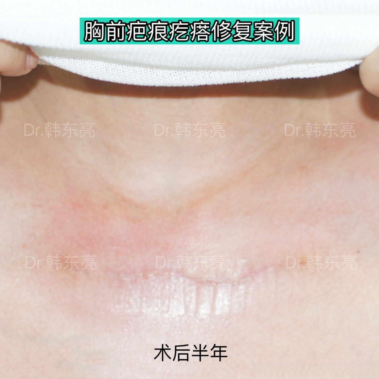 【胸前疤痕疙瘩治疗案例.