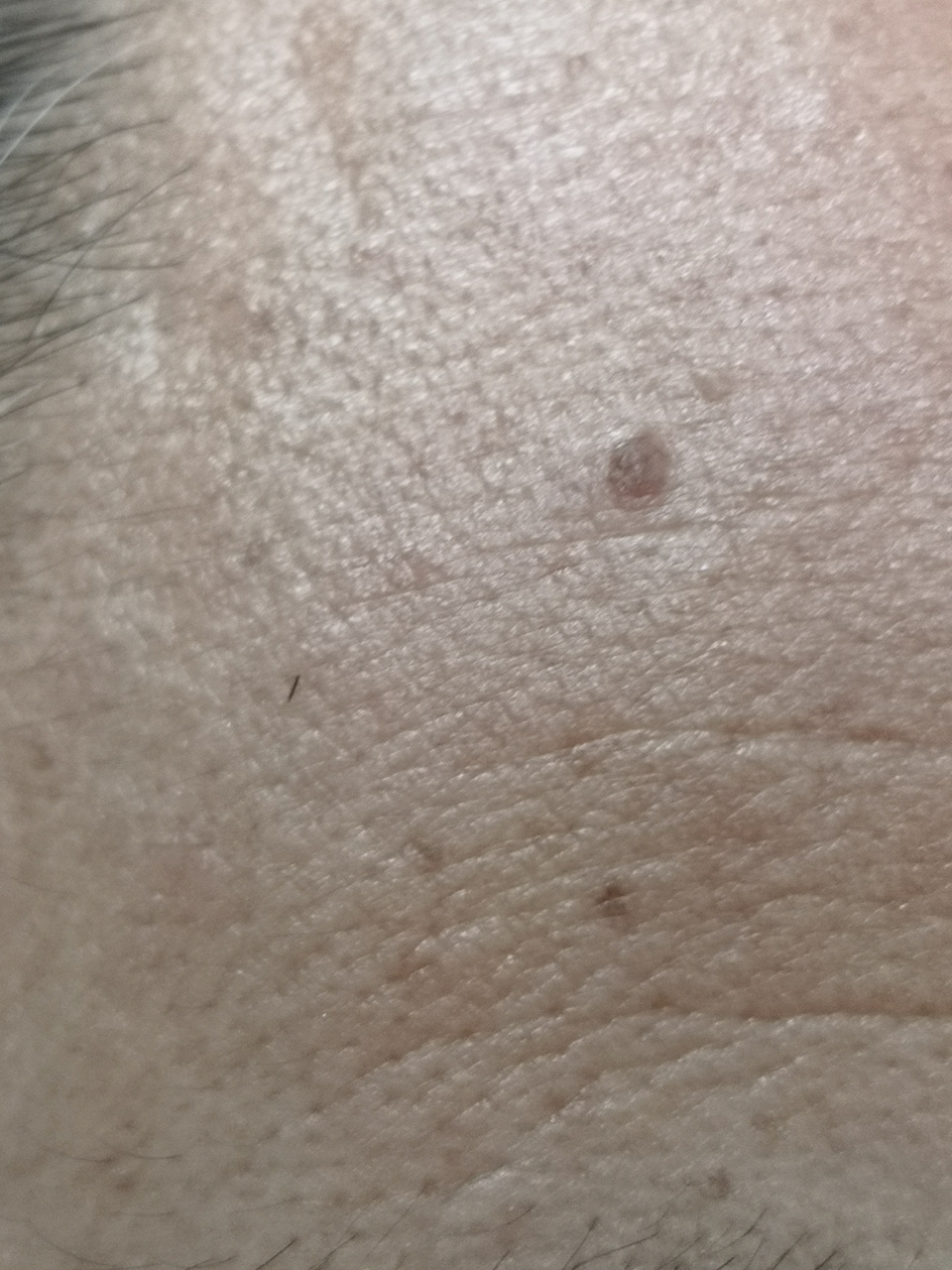 眼睑额头脂溢性角化/老年斑症状.可以使用激光治疗去除.
