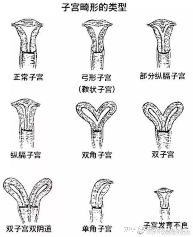 畸形双子宫双宫颈图片图片