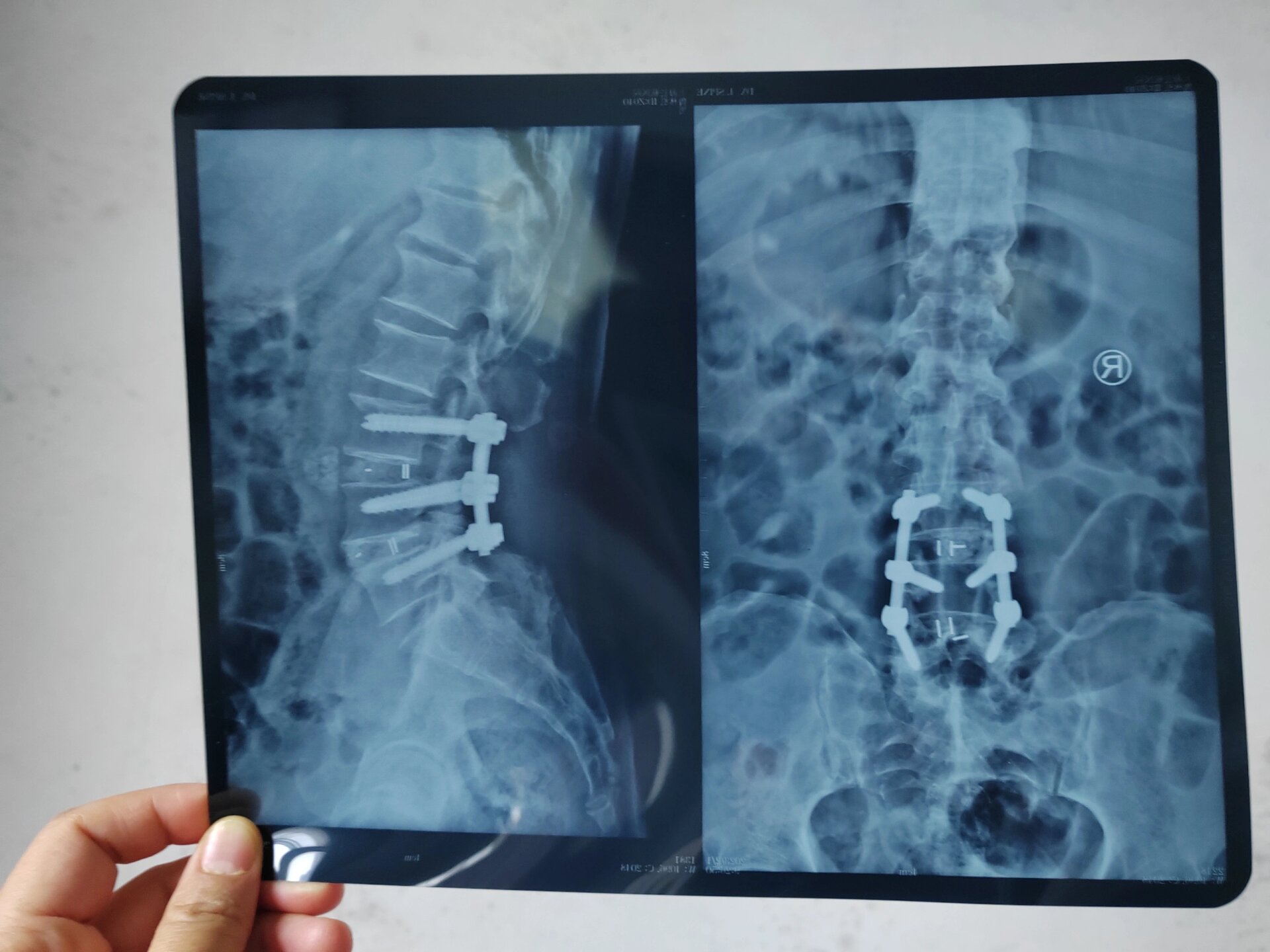 腰椎开放融合术6个钢钉