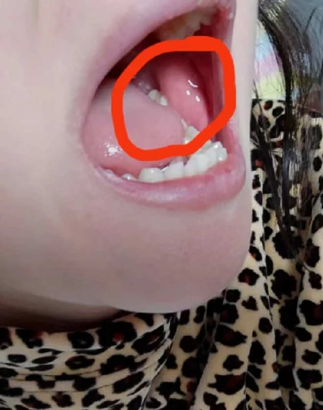 脸颊里面的口腔内壁长肉包,常见原因包括饮食刺激,口内淋巴结肿大或