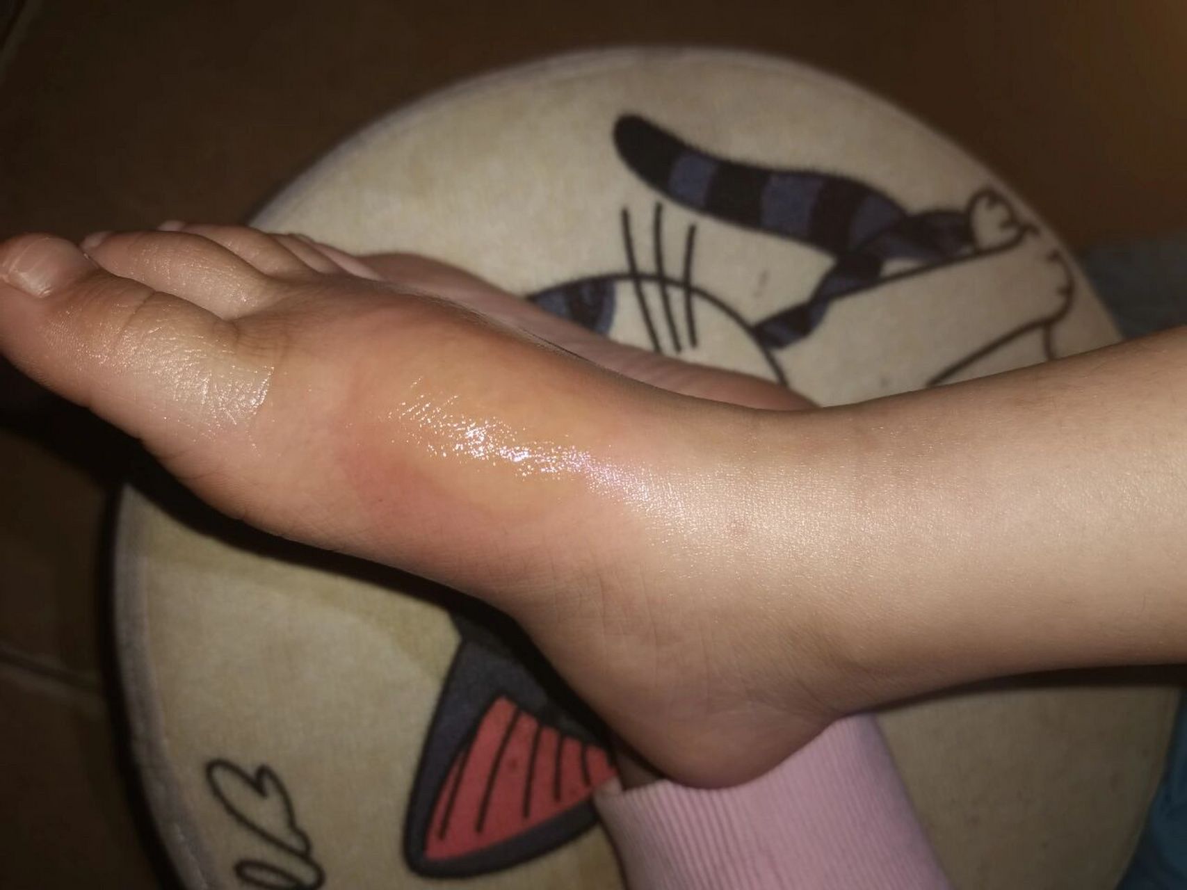 脚肿 去了趟草地,脚就成这样了,不是第一次,究竟是什么原因?