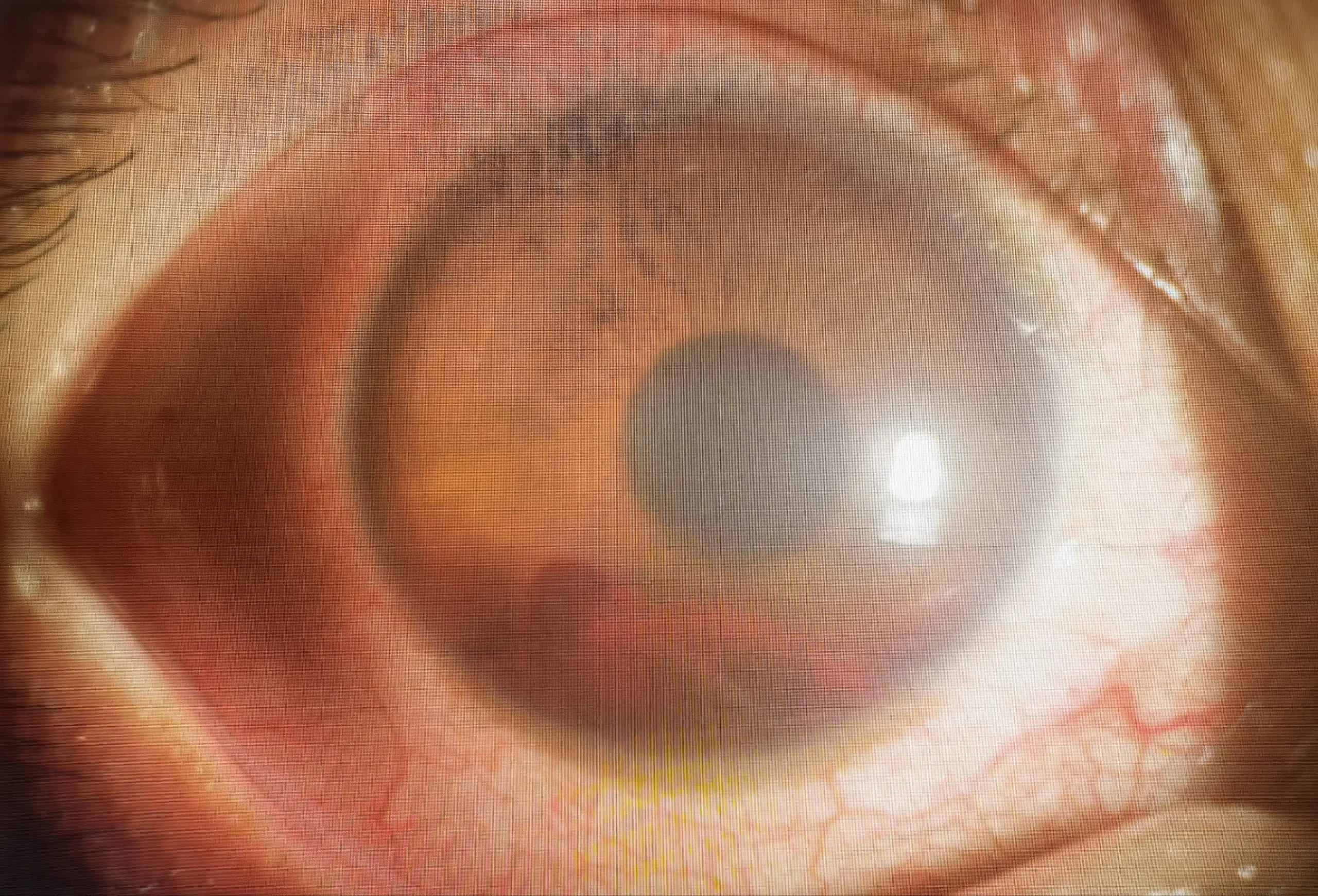 近期经常碰到因为工作和打球而眼睛受伤,导致前房积血,继发性青光眼的