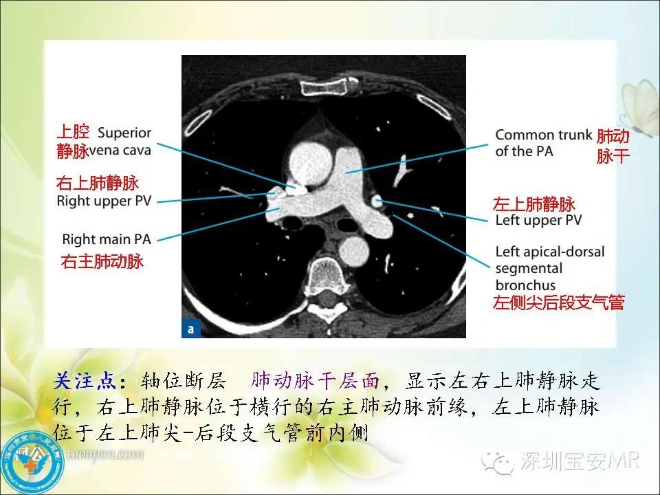 江湖救急 肺动脉cta怎么做啊 家人们 飞利浦64排  光做过冠脉没做过肺