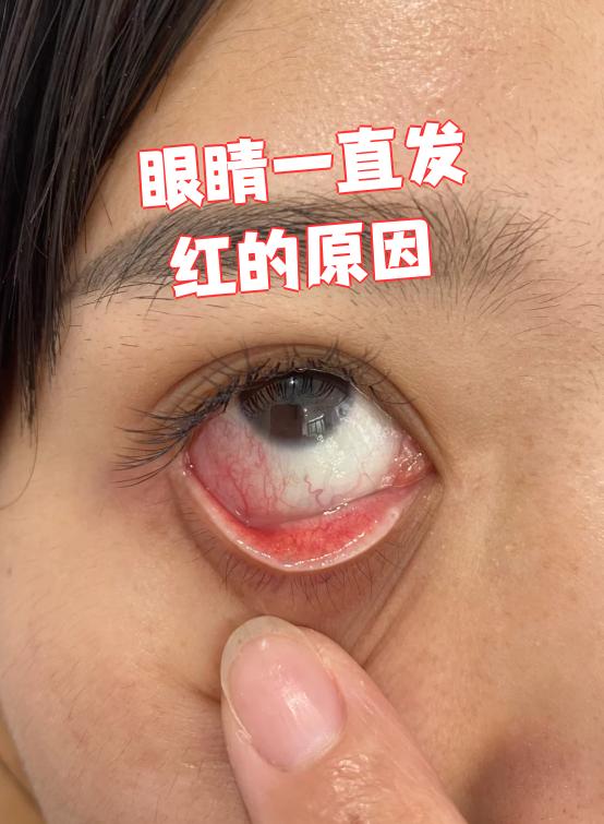 眼睛一直发红最常见的原因是干眼症,角膜炎或急