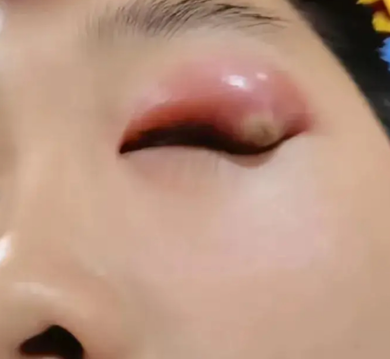眼角红肿疼最常见的原因是睑腺炎