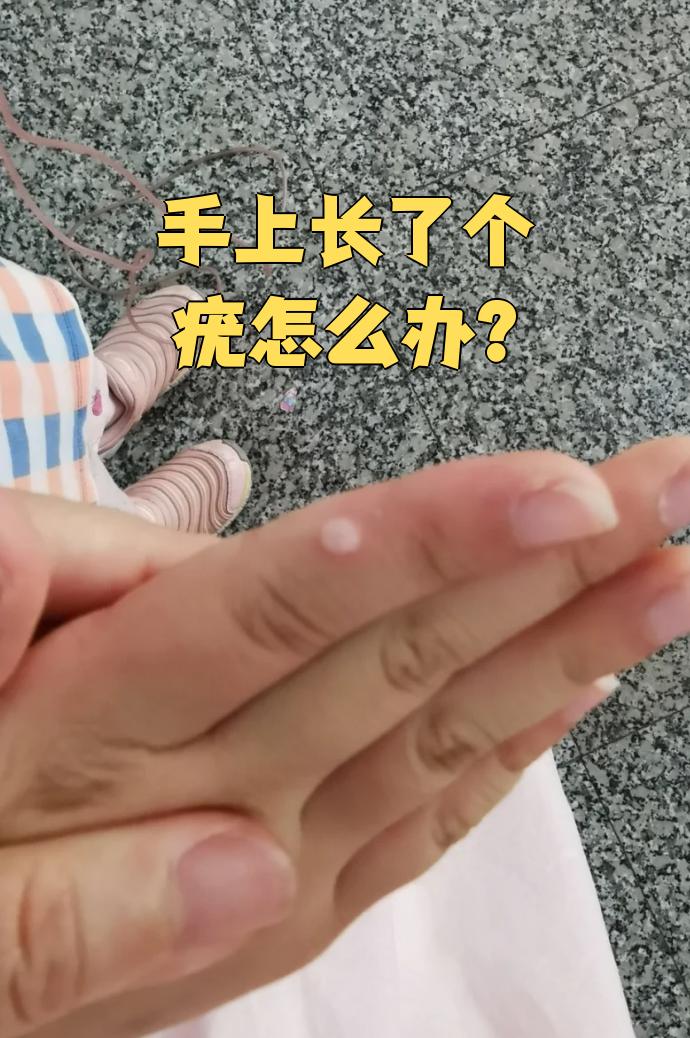 手上长疣通常是人乳头瘤病毒(hpv)感染引起的,常见的是hpv 3型或10