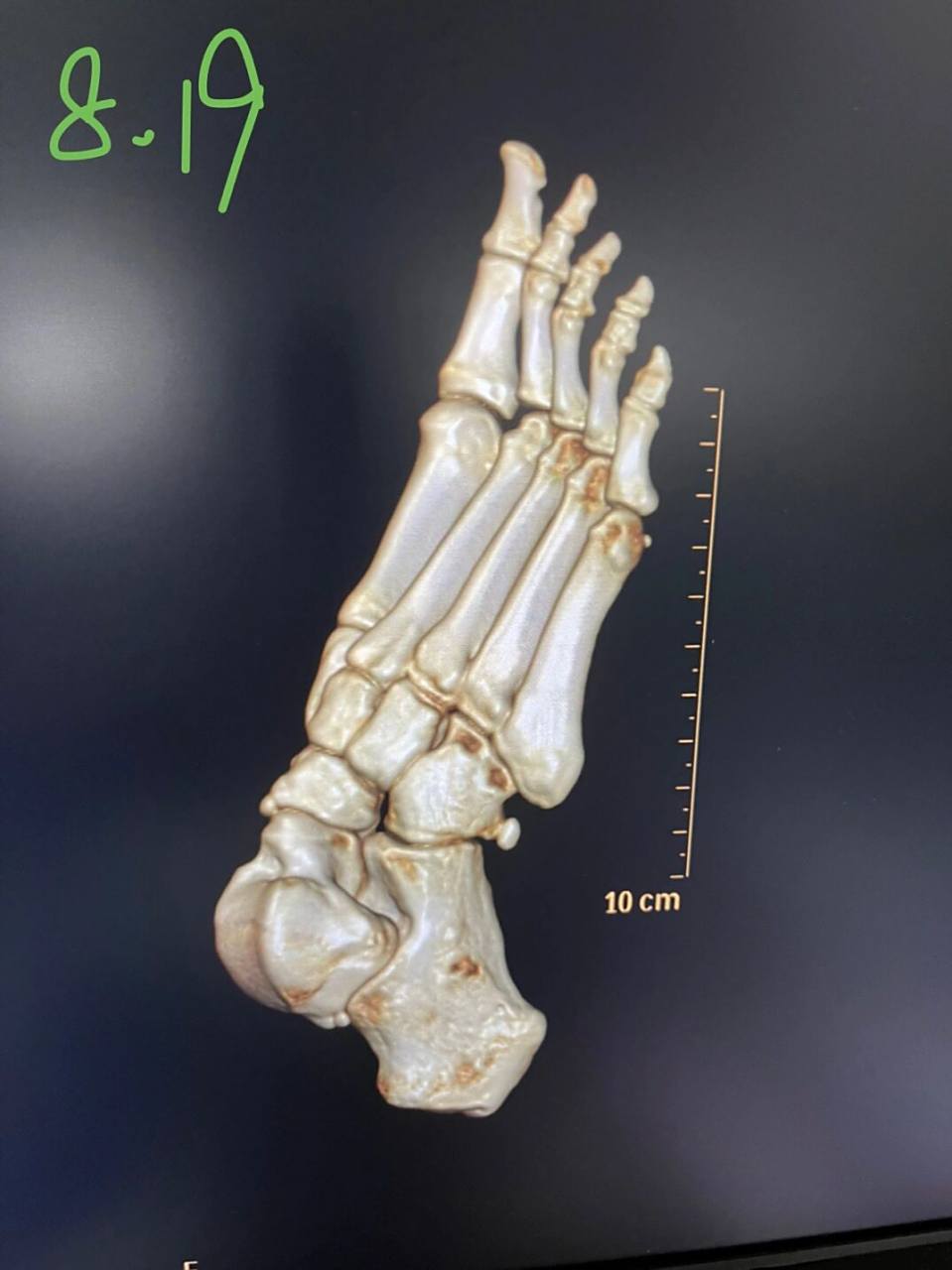 骰骨撕脱性骨折第30天 7.