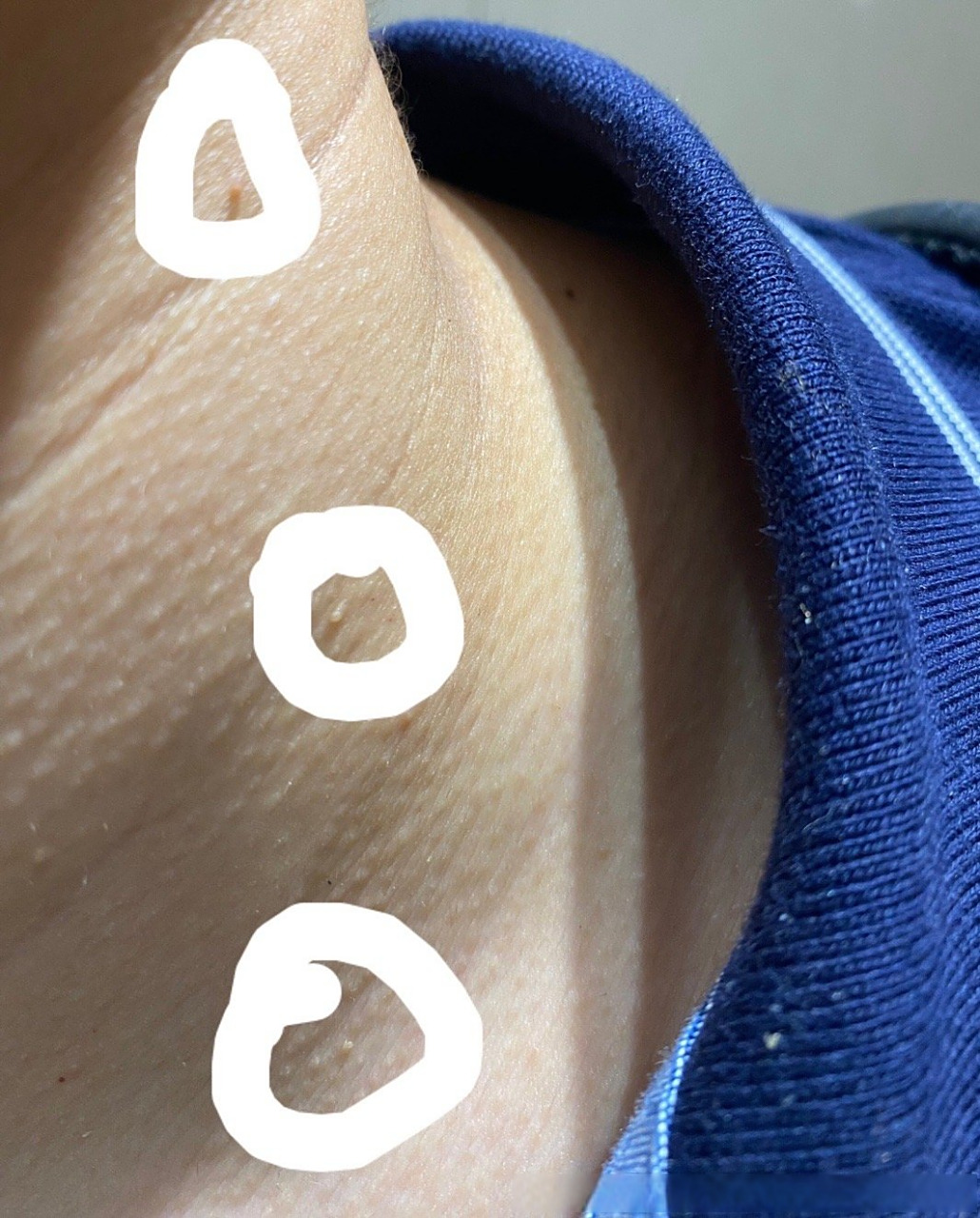 近期几天发现脖子上起了几个小肉球,担心是hpv 询问这个情况是否严重