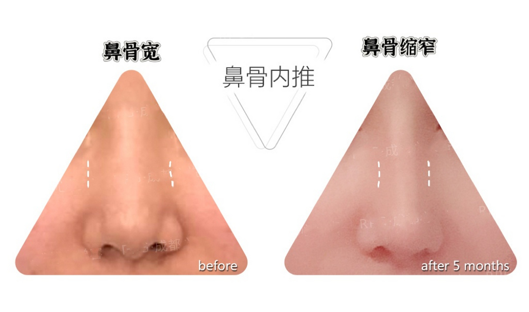 但是正面鼻梁显得不高,一般是因为鼻梁宽的原因,可以采用鼻骨内推截骨