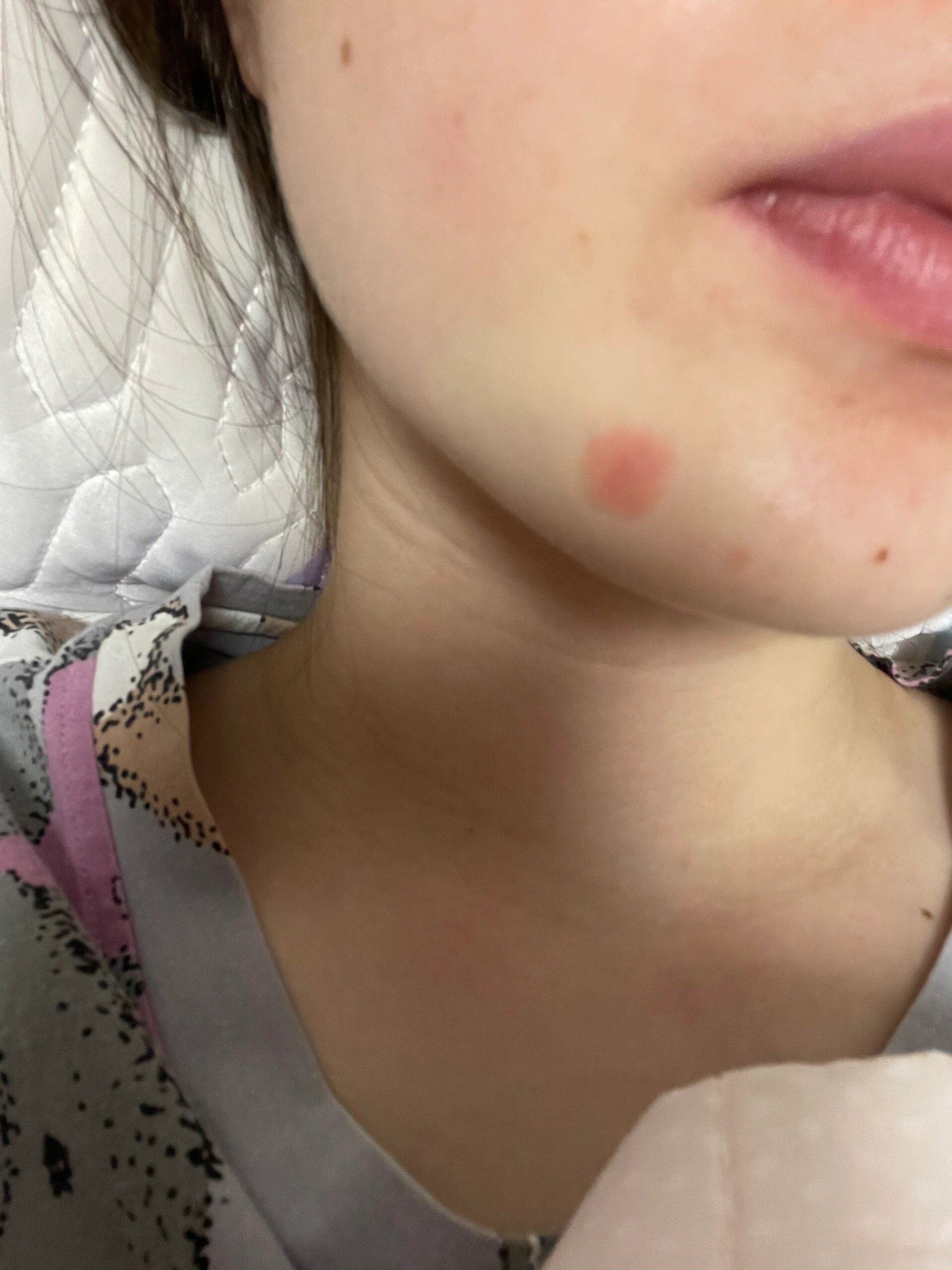 脸上一块红不痛不痒每天脱皮