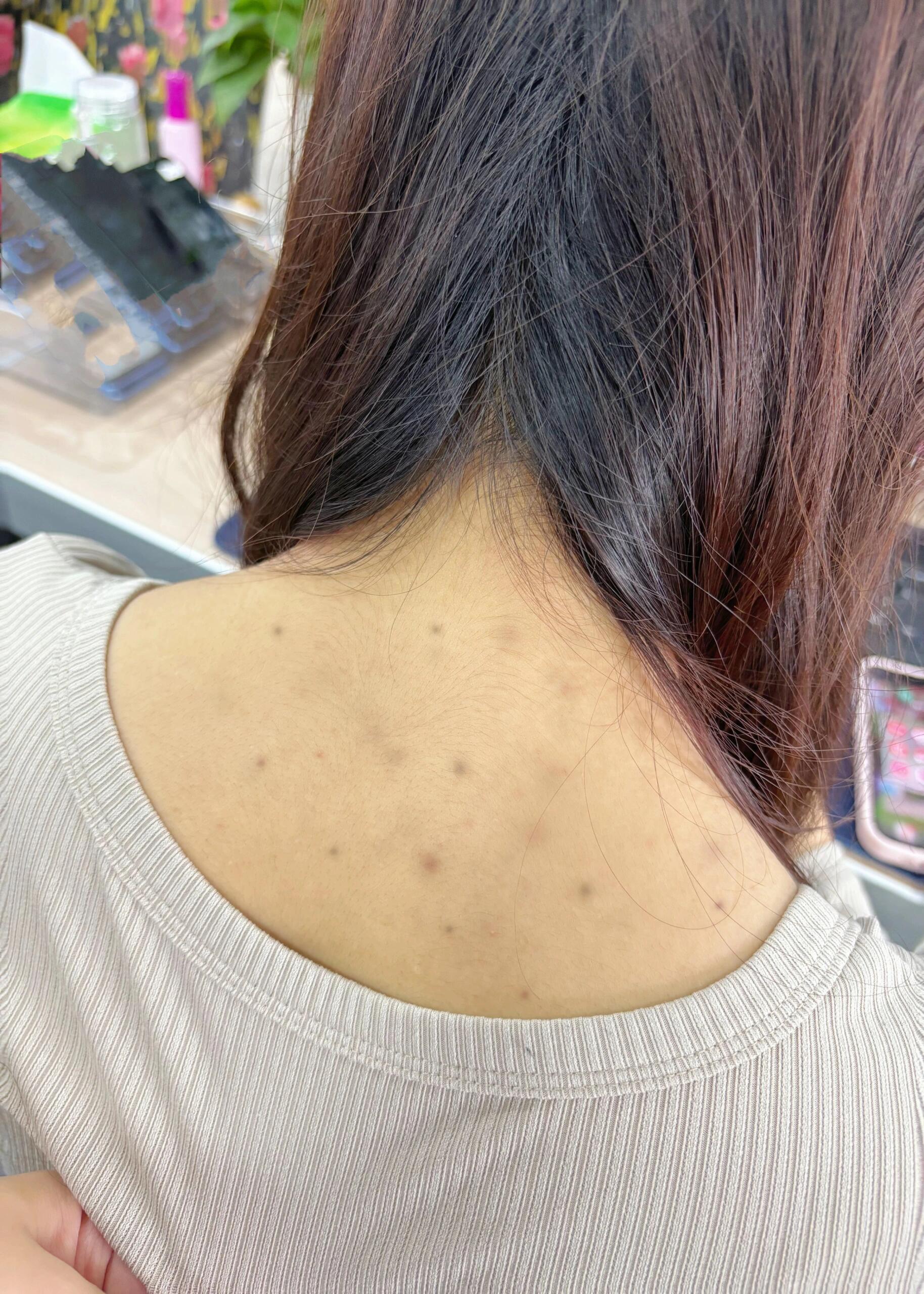 生活作息不规律真的会长疣,长了疣可真的不能拖哦~ 每天可以用盐水