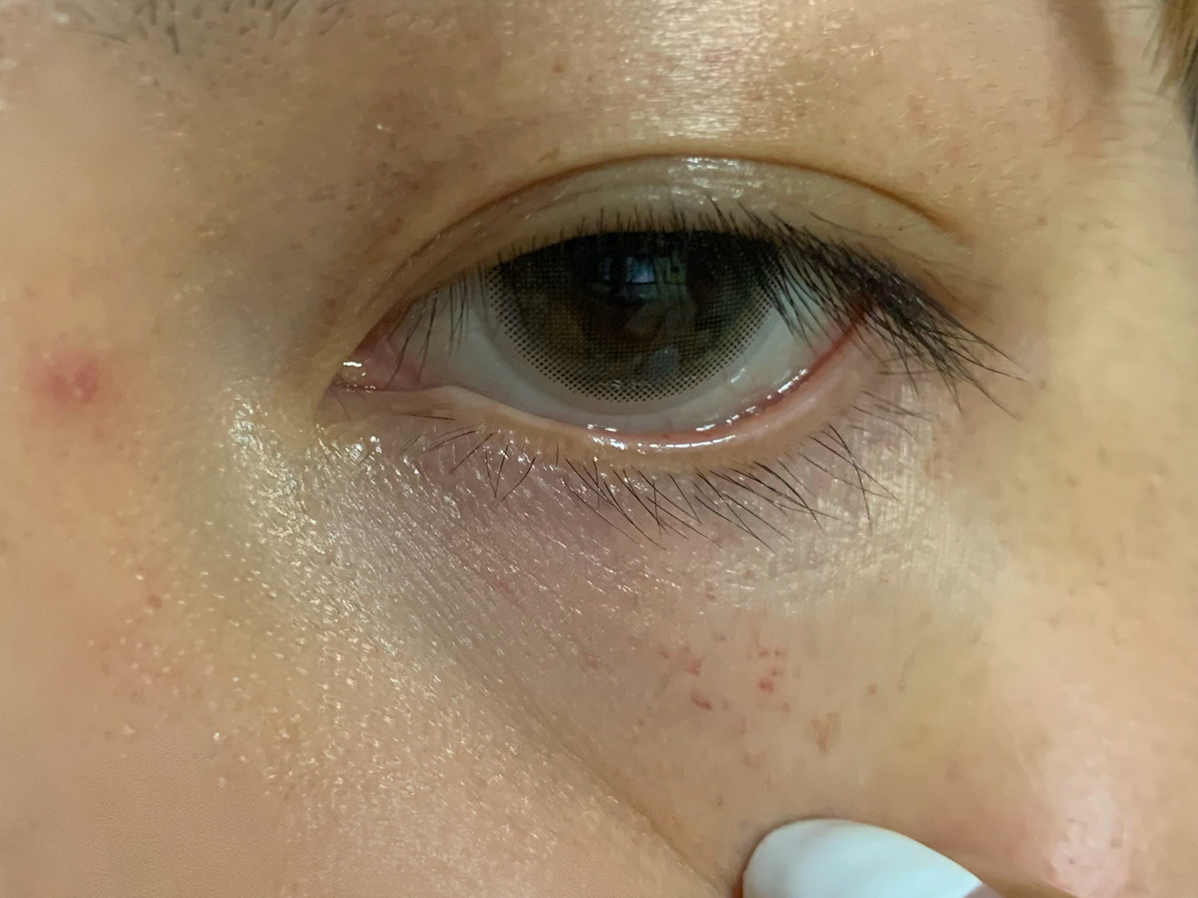 上下眼皮都是小红斑 早上起来就发现眼周一圈都是红斑,过了一早上了一