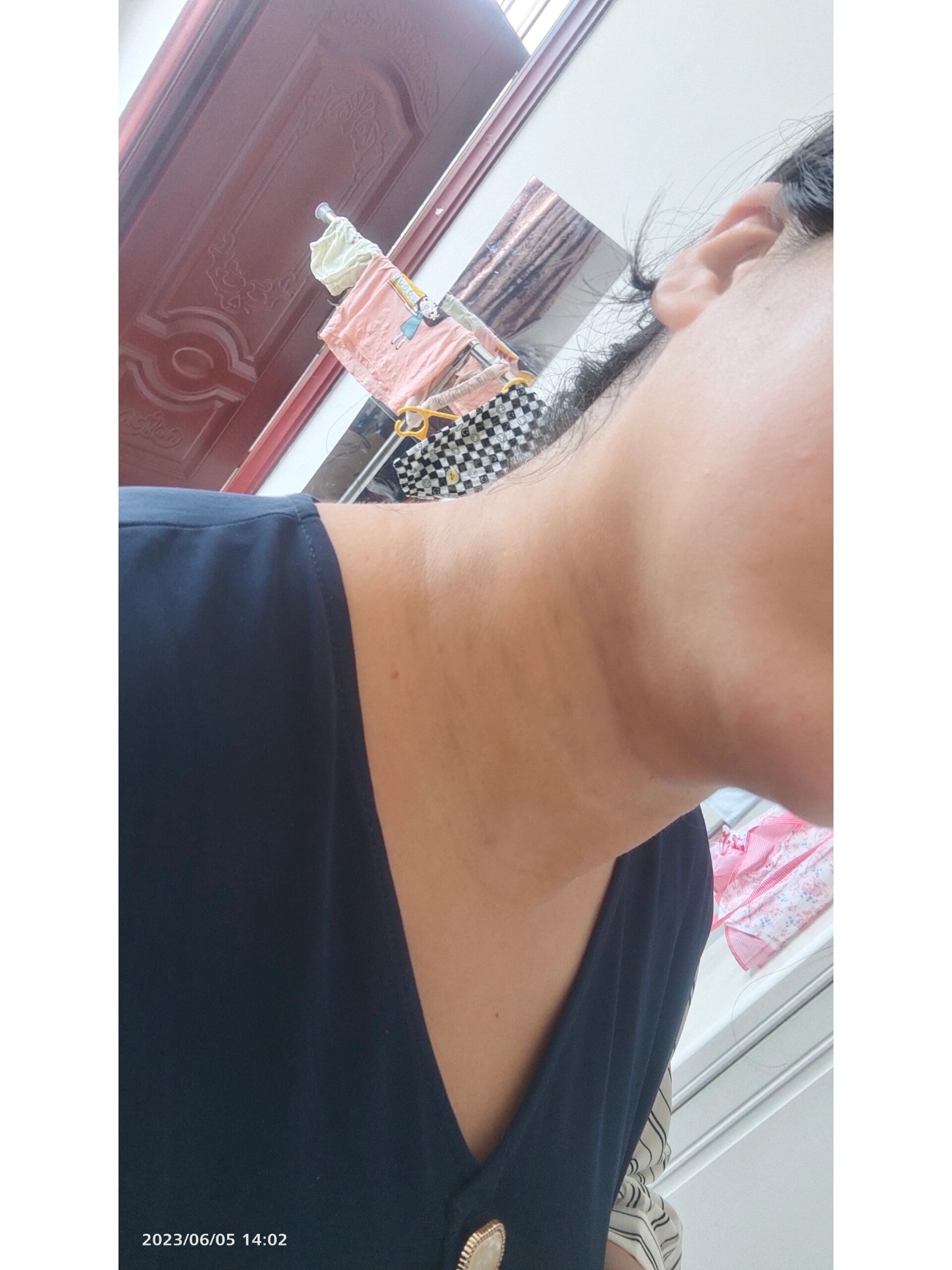 脖子黑色素沉积严重