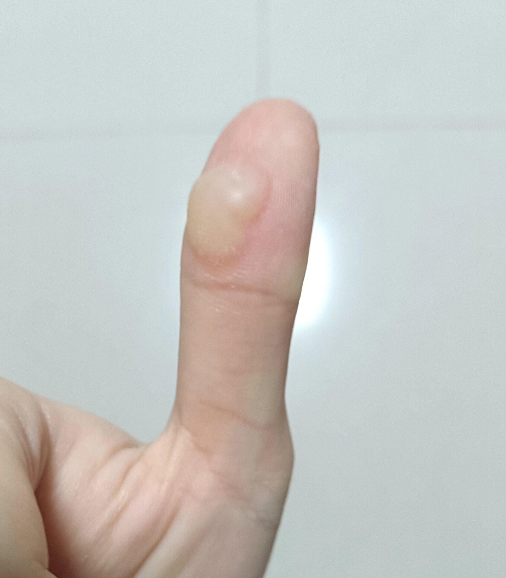 烫伤后的水泡要刺破吗 真的不想刺破它,感觉好痛啊,能不能等它自己