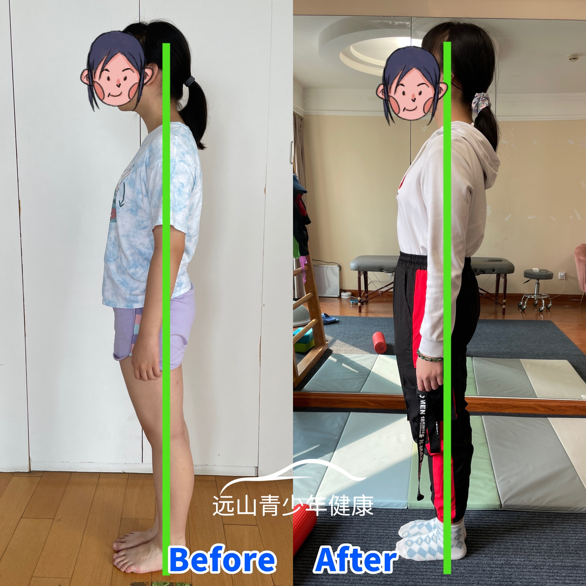 13岁女孩驼背探颈如何矫正