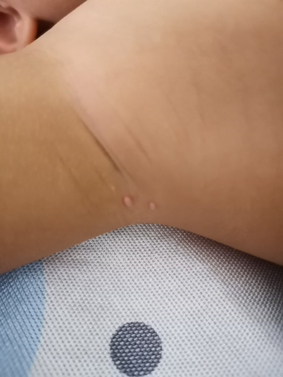 求助,宝宝传染性软疣能自愈吗 请问大家一岁多宝宝长了传染性软疣能