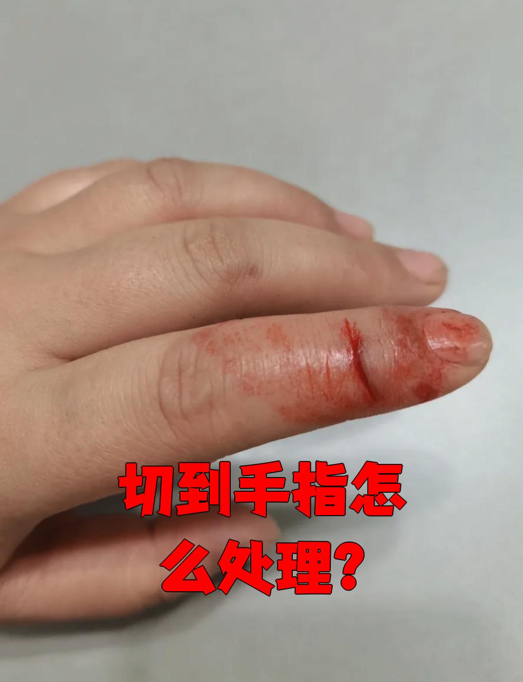 手指被切伤后,按顺序做好这几步就行: