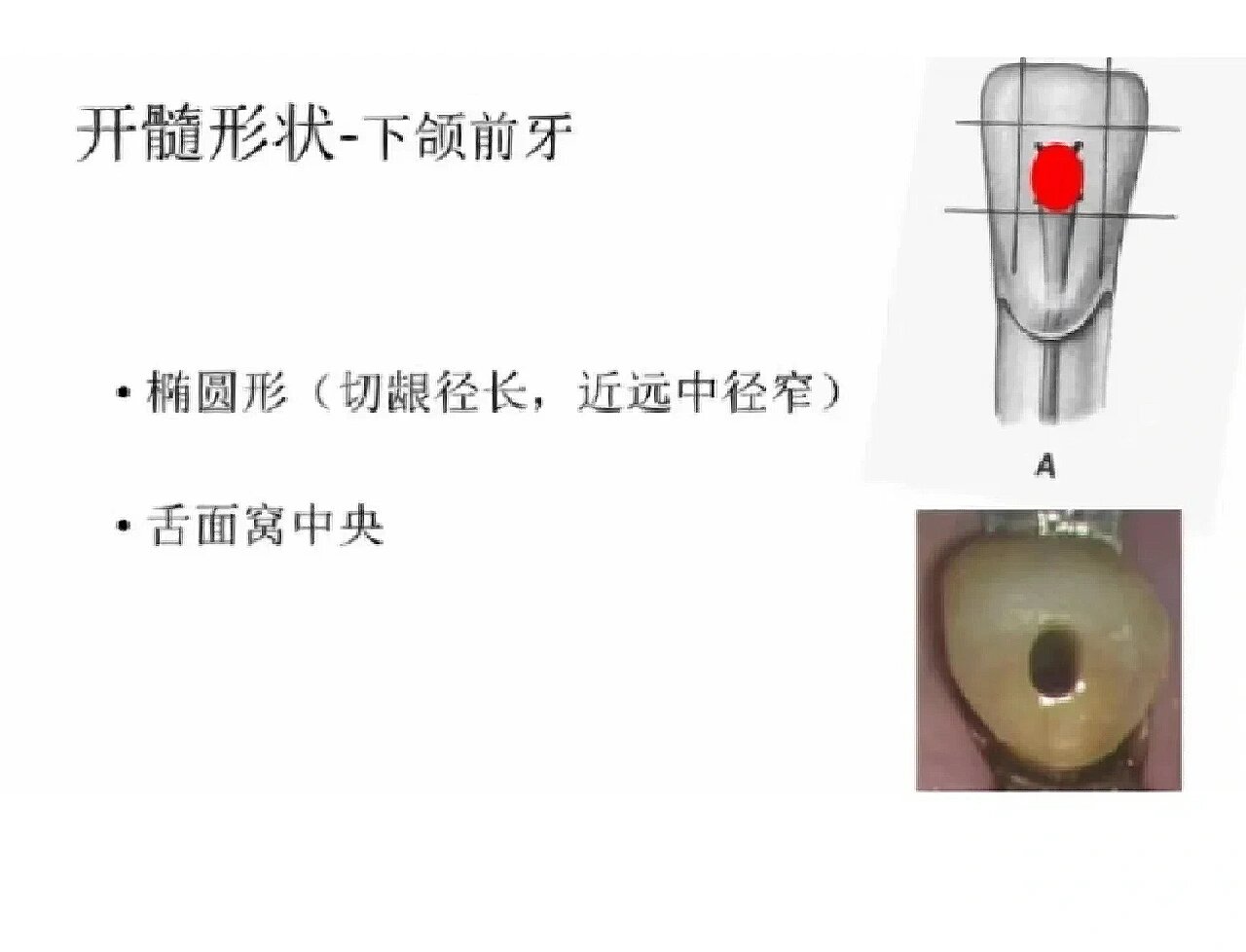 下颌中切牙髓腔形态图片