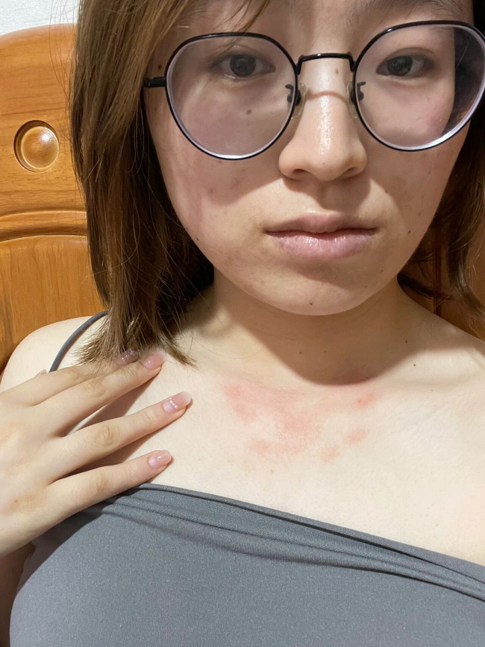 汗水过敏? 一出汗好痒我就挠然后就一大片红疹.98