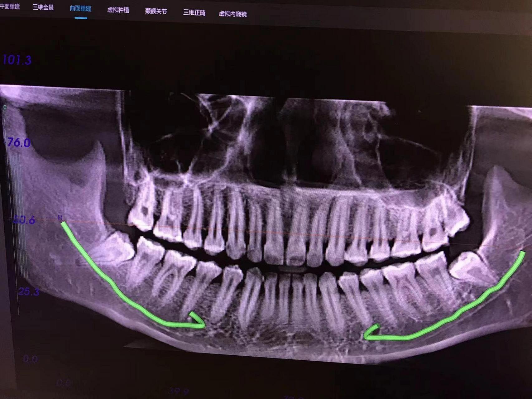 阻生智齿x光片图片