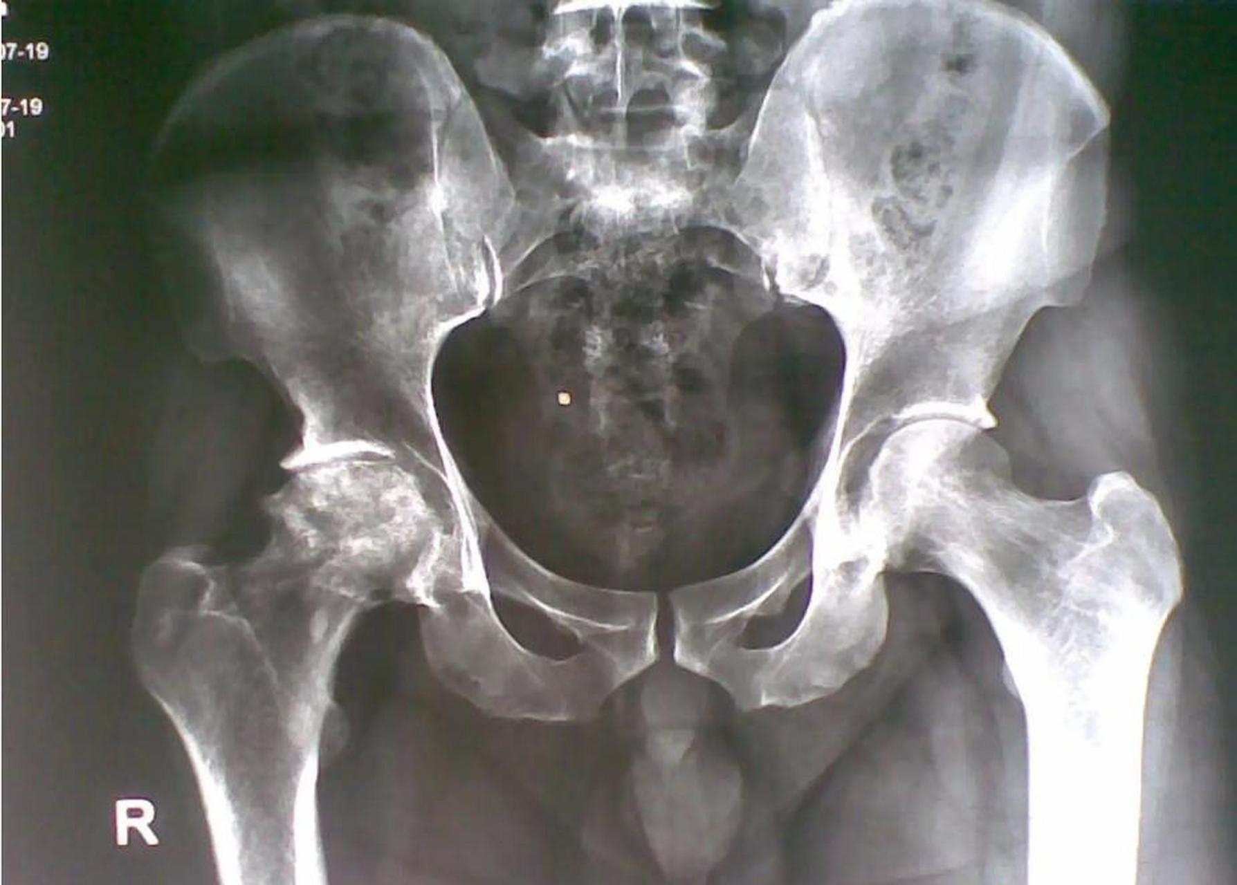 股骨头坏死三期怎么治疗控制的好?