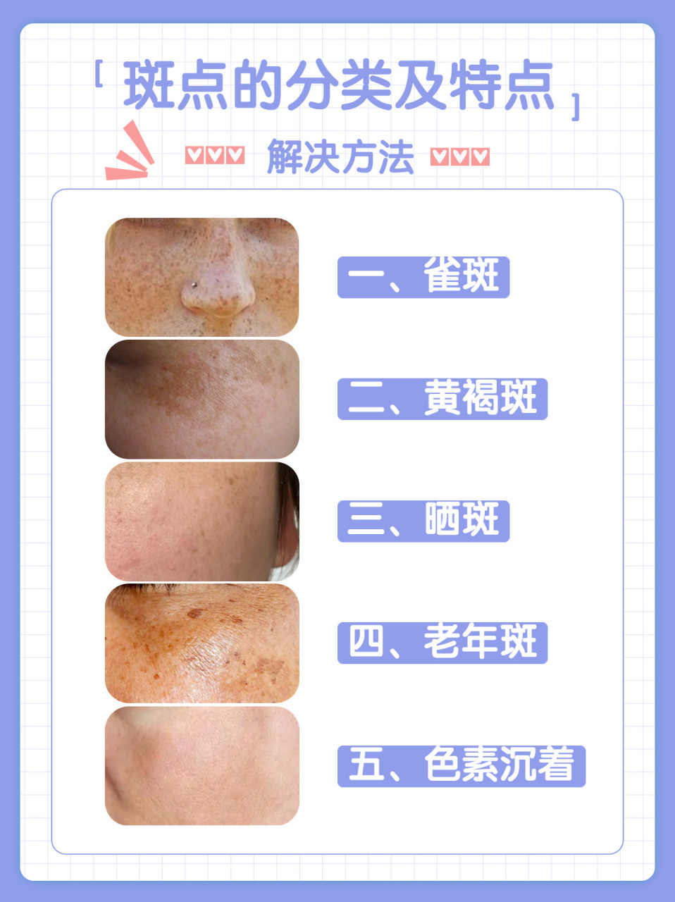 斑点的分类及特点你是哪种类型的呢7571