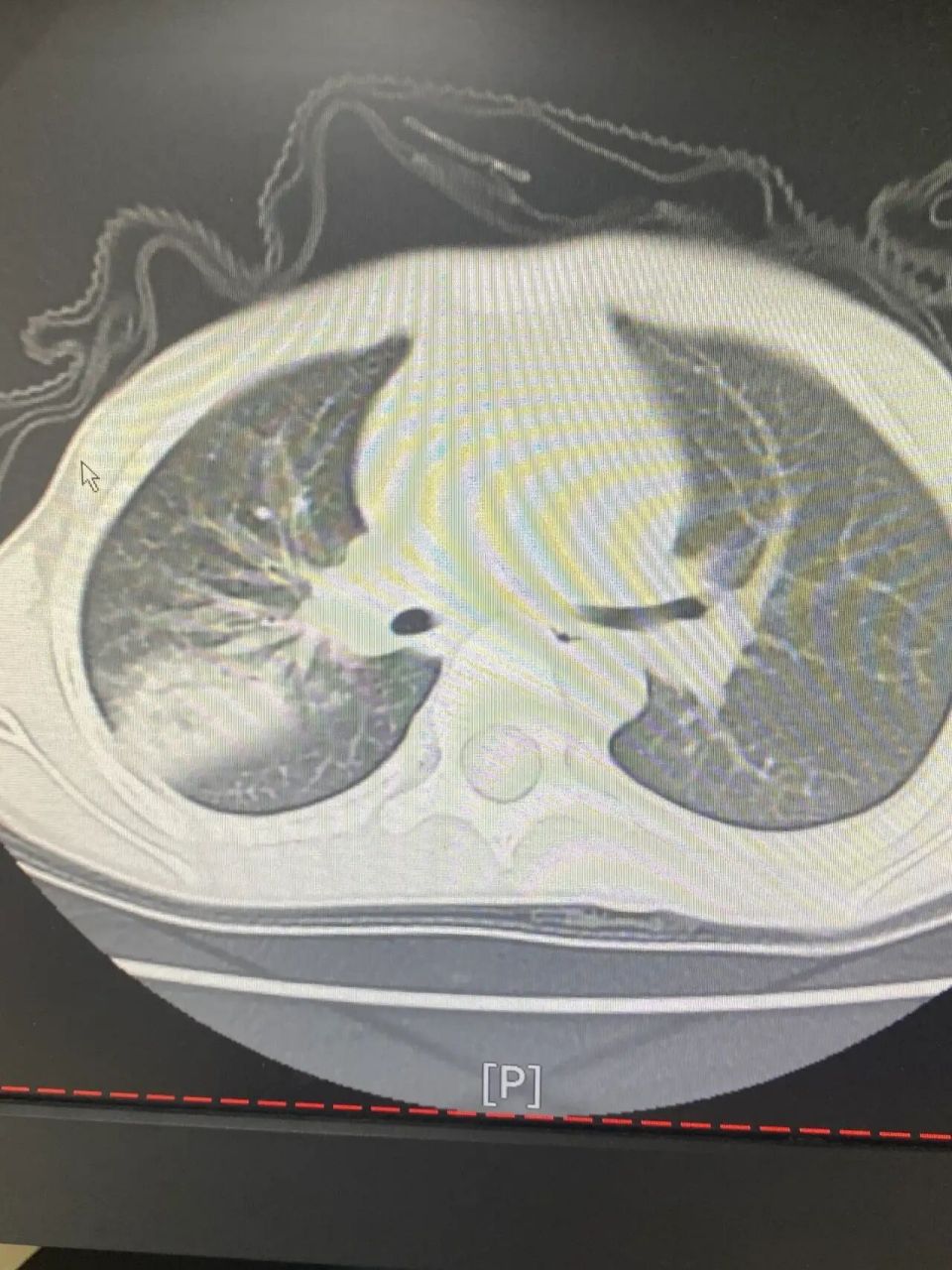 小儿重症肺炎有什么症状? 小儿重症肺炎表现 1,中心紫绀或血氧饱和度