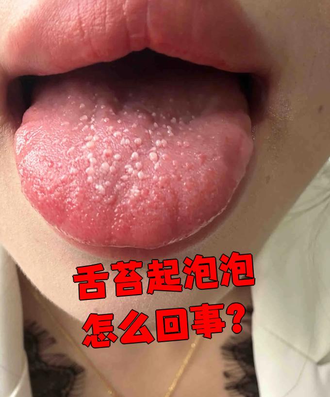 如果吃了太烫的食物,舌头被烫伤后黏膜受损,就可能起泡