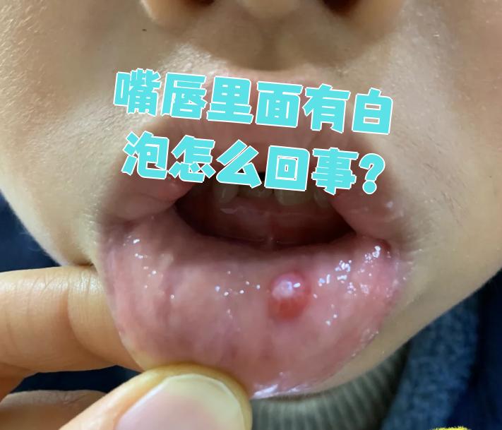 嘴唇里面长白疱,最常见的原因是黏液腺囊肿