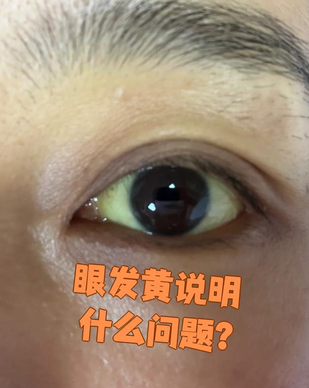 黄疸是因为胆红素代谢异常导致血液里胆红素升高