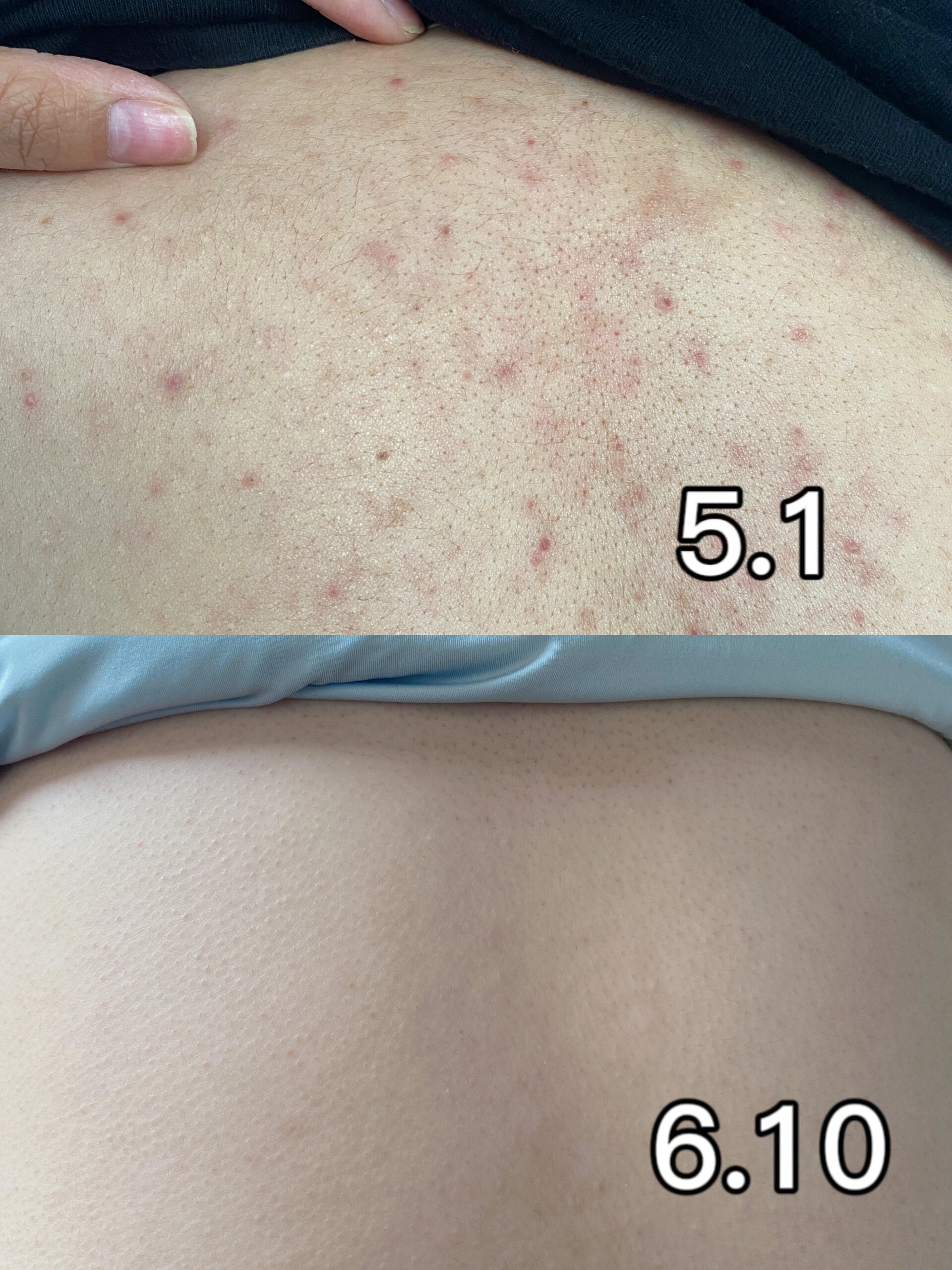 希望所有后背脂溢性皮炎的姐妹都能刷到!不 真的没想到这个介么牛掰!