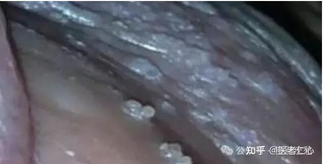 尖锐湿疣如何用醋酸白检测