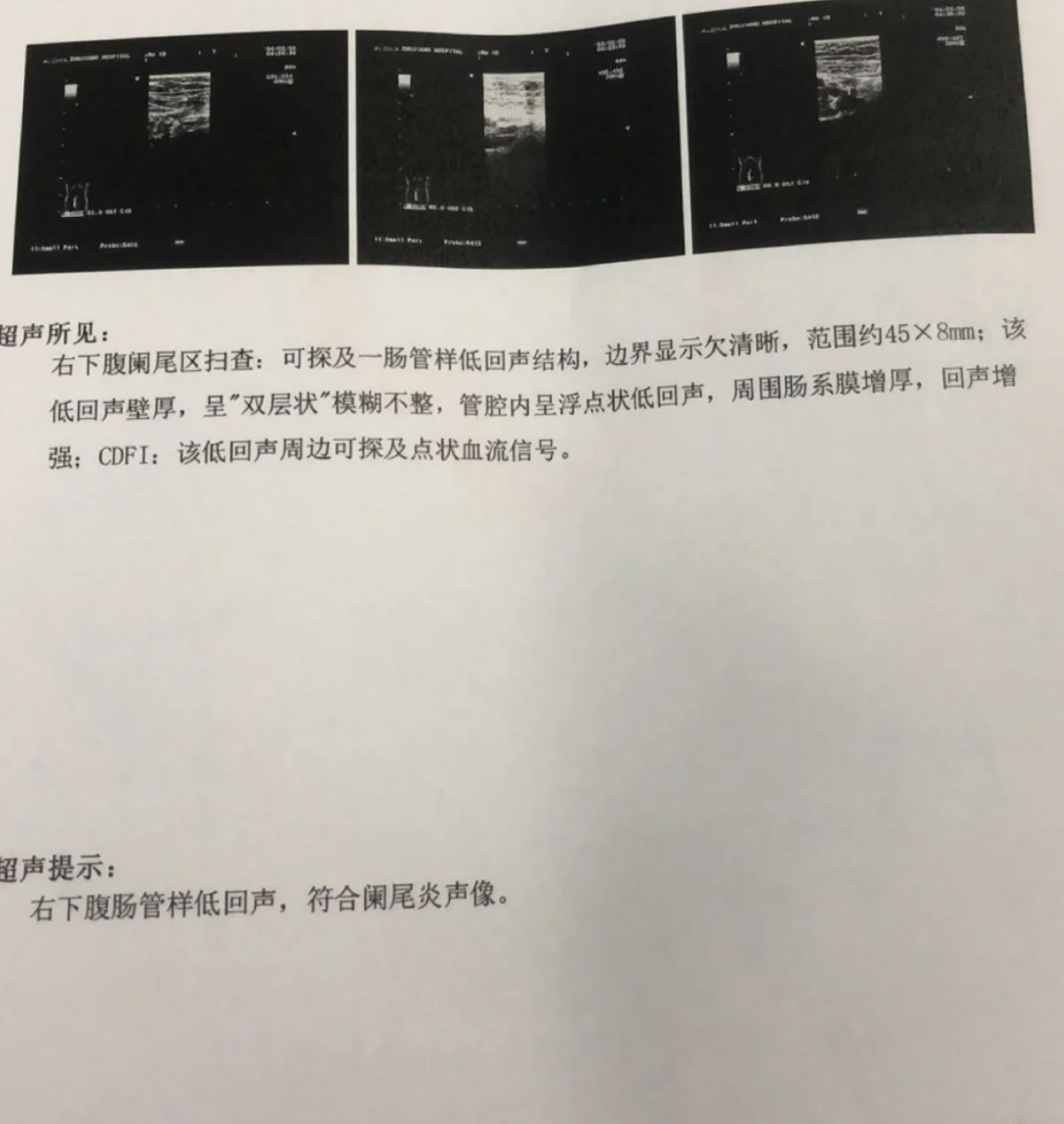 最常见的原因有三个:肠道息肉病变,阑尾炎或者肠道肿瘤