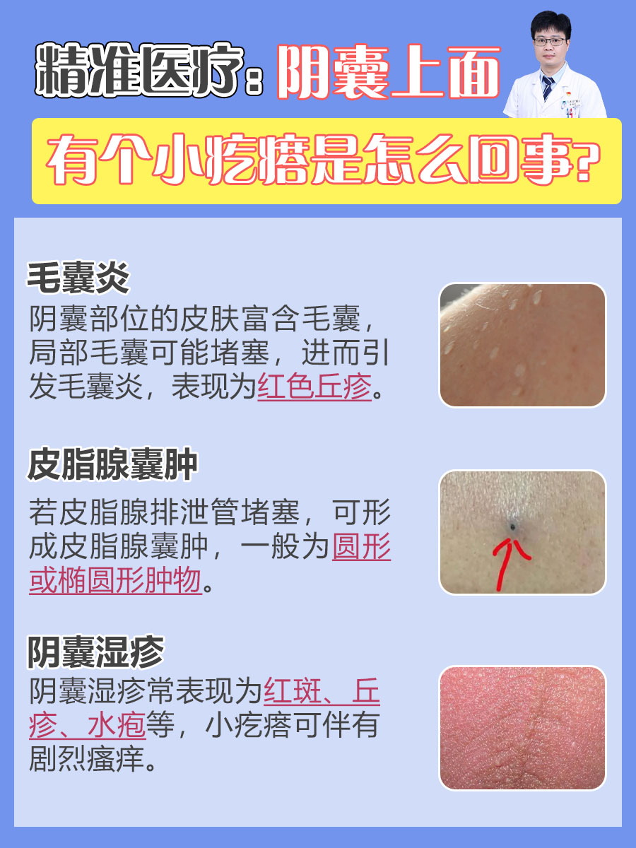 阴囊上面出现小疙瘩是一种较为常见的现象,可能由多种原因引起,如毛囊