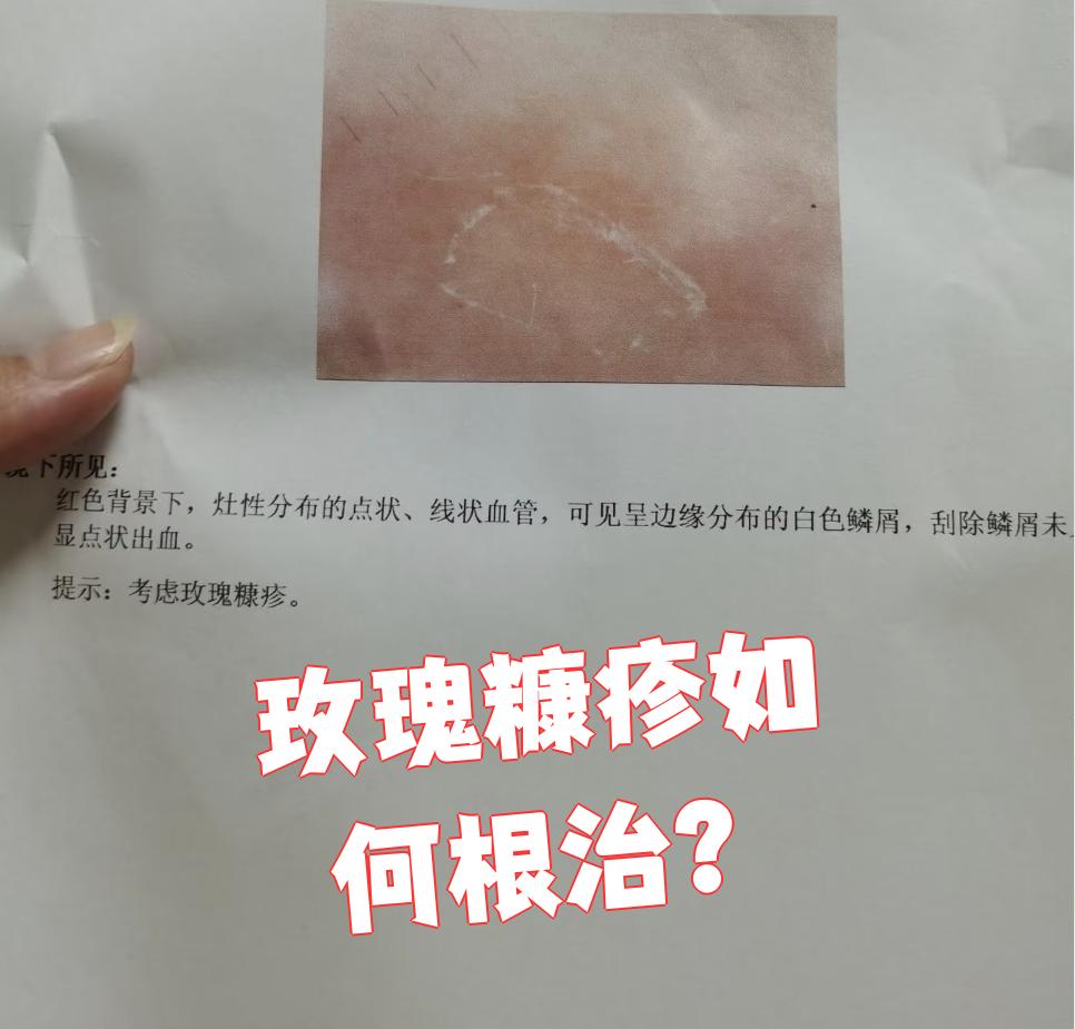 玫瑰糠疹如何根治?