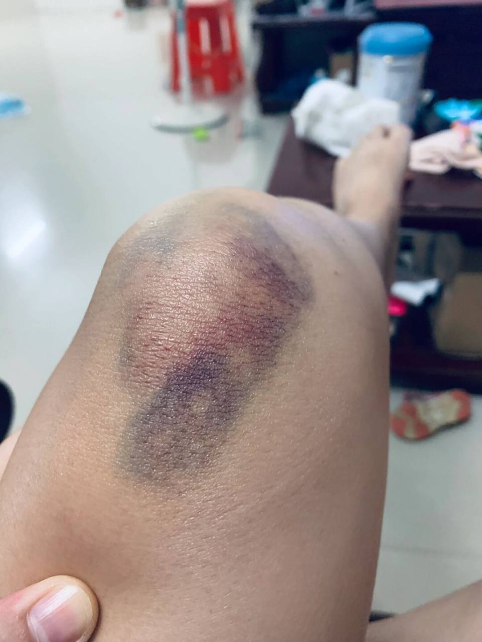 关于2022年8月14号骑电动车摔伤后到现在 八月回家了一趟,突然看见家