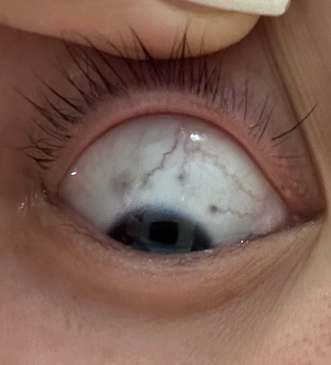 眼睛白眼球有黑点可能和这些情况有关: