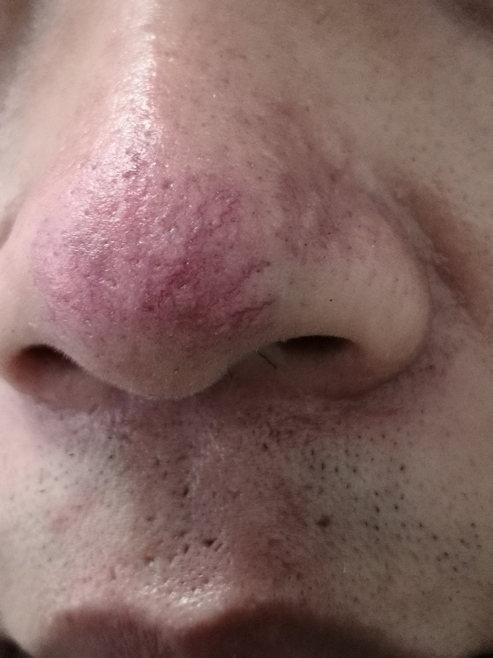 酒糟鼻症状.可以使用激光治疗去除红血丝和肥厚性斑块.