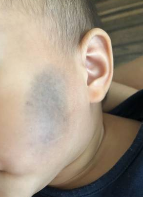 为什么婴儿有胎记