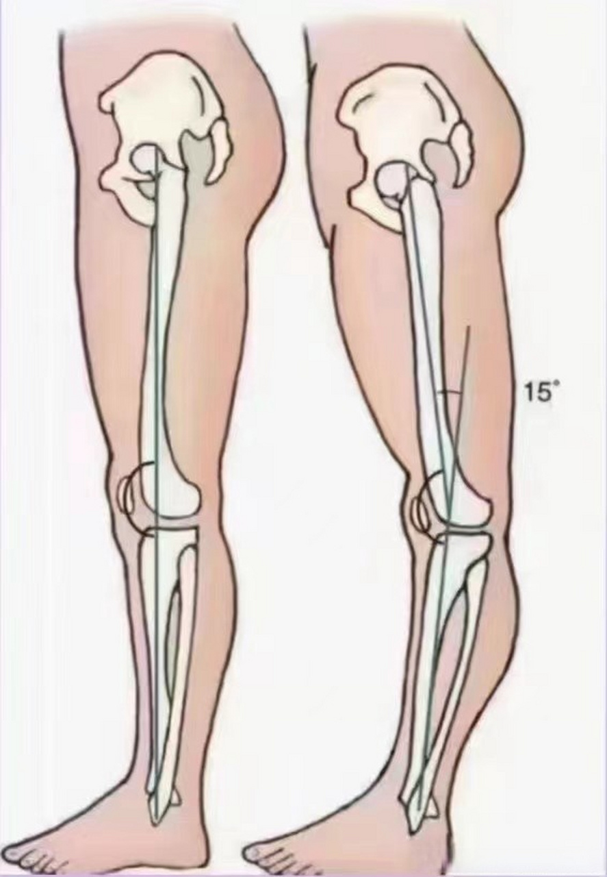 膝关节超伸有什么危害?