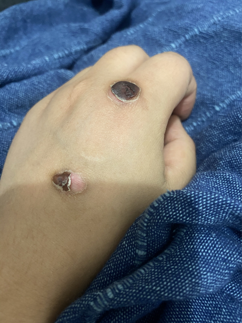 分享一则液氮冷冻痊愈过程! 一定不要沾水!不要沾水!不沾水!